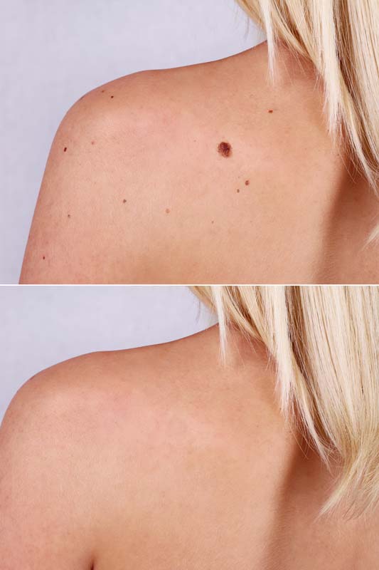 expert mole removal santa clarita california