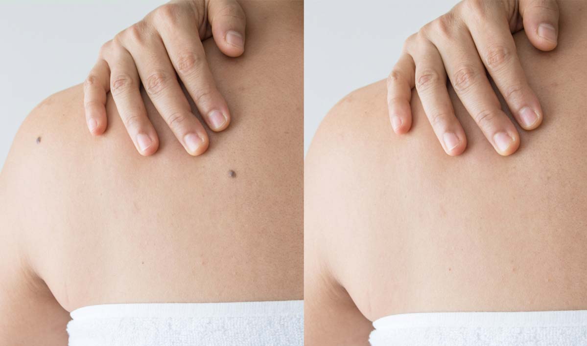 professional-mole-removal-oxnard-california professional mole removal oxnard california