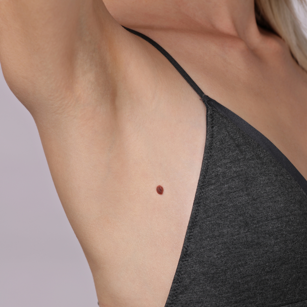 scarless mole removal Agoura Hills
