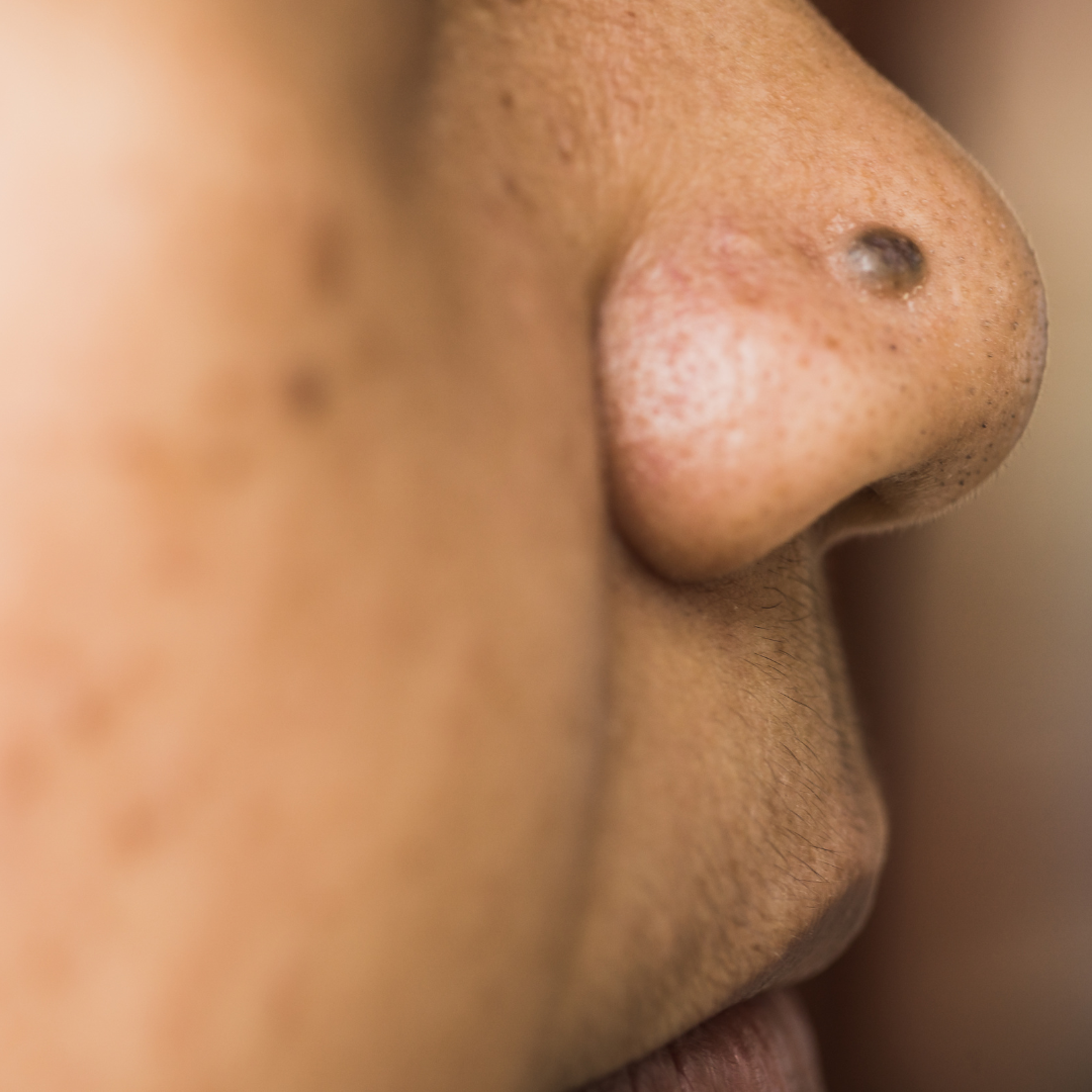 affordable mole removal encino california