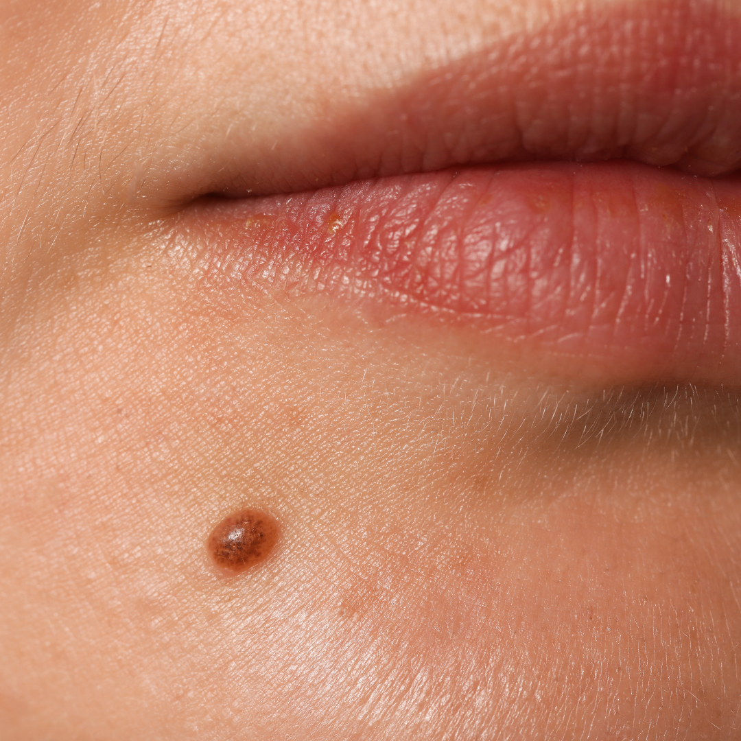 scarless mole removal west hills california