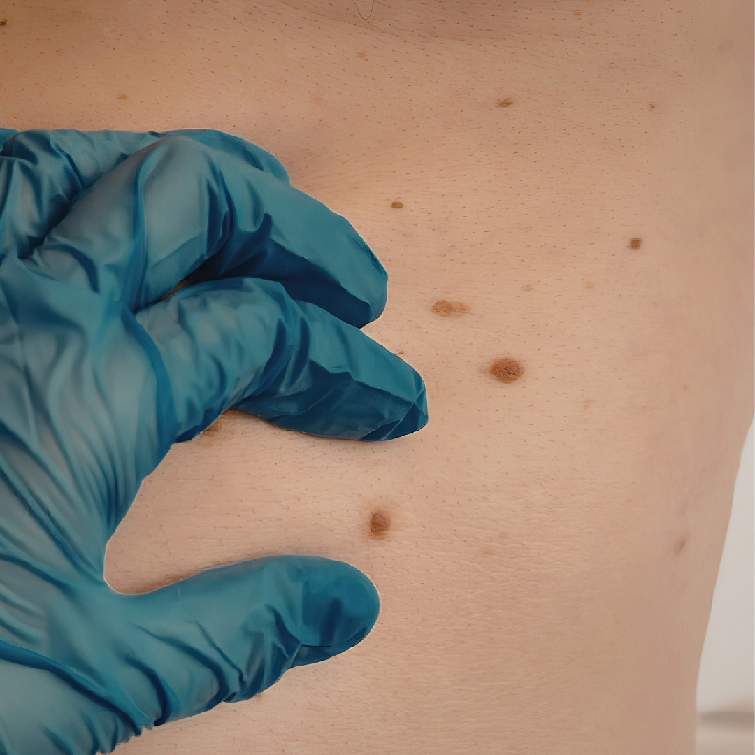 affordable mole removal Chatsworth California