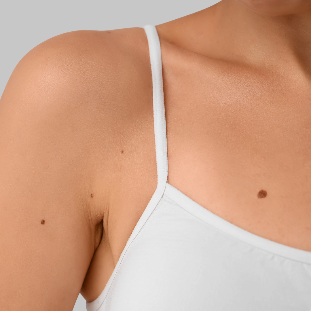 professional mole removal Santa Paula California