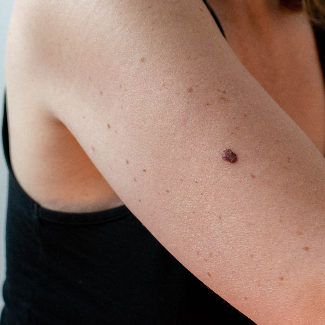 scarless mole removal Port Hueneme