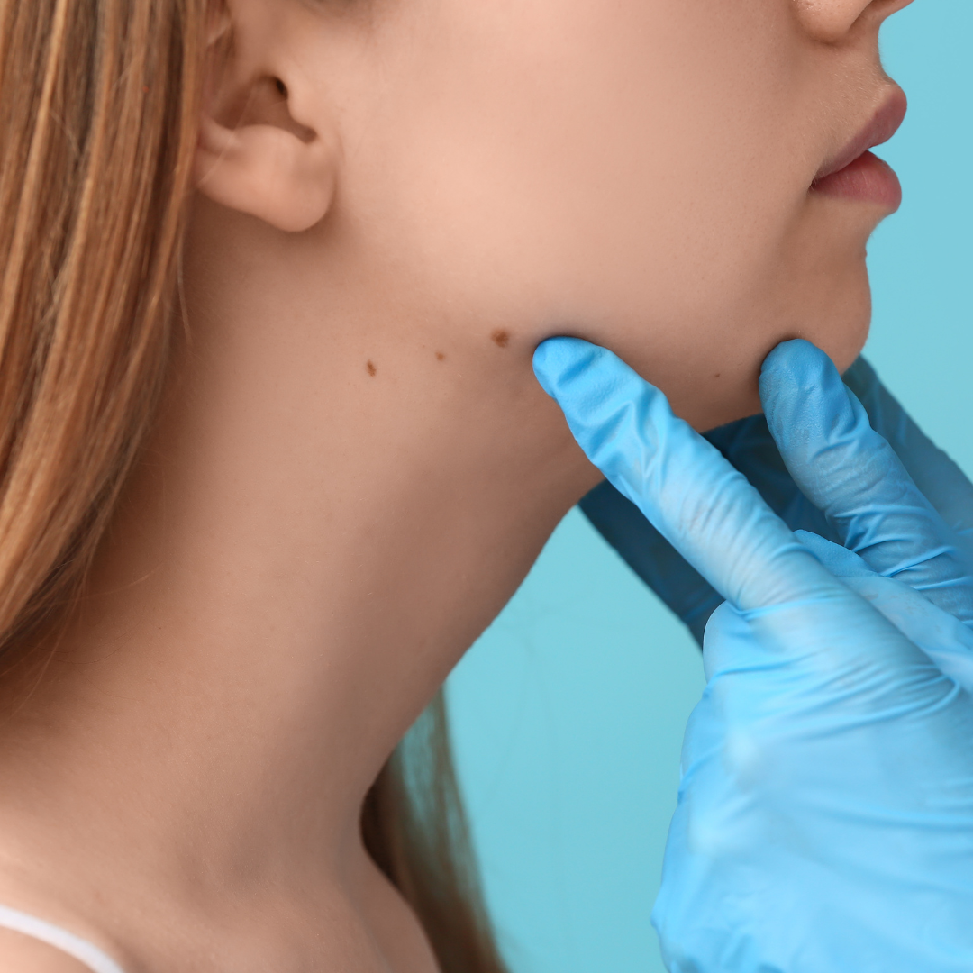 The Risks of At-Home Mole and Skin Tag Removal Methods